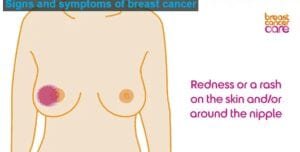 symptoms-of-breast-cancer